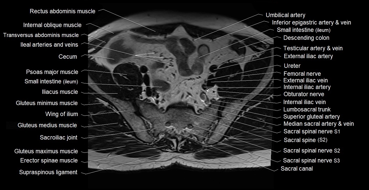 Male pelvis axial cross sectional anatomy image 5.webp